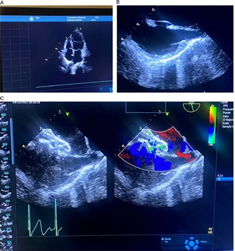 Echocardiography Images After Anticoagulation Treatment And Follow Up