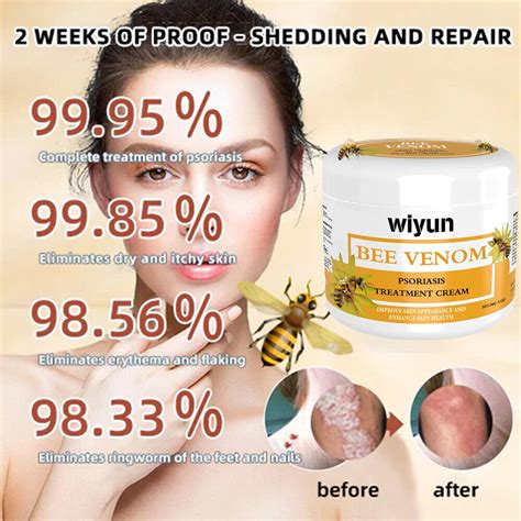 Bee Venom Psoriasis Relief Cream Grelly Uk