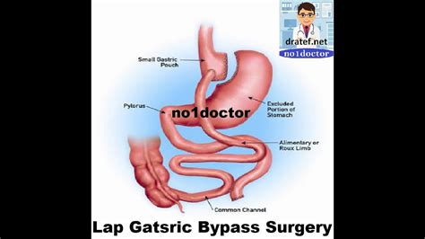 Lap Gastric Bypass Bariatric Surgery Lap Gatric Bypass Surgery Weight Loss Surgery Mrcs