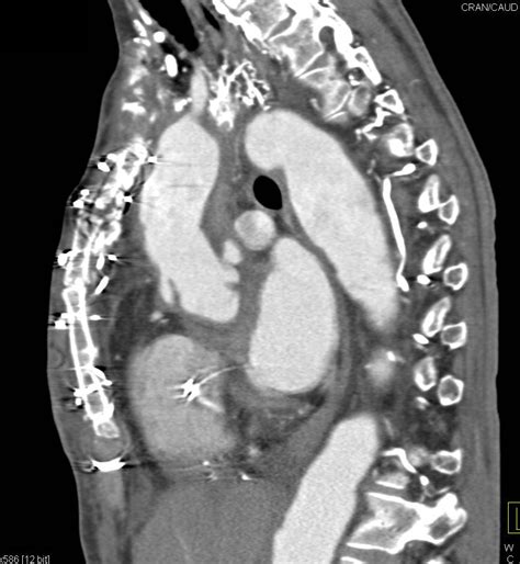 Aortic Dissection CT Scan