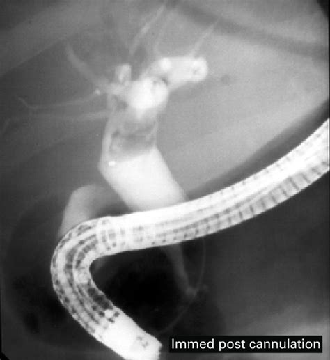 A Cholangiogram Endoscopic Retrograde Cholangiopancreatography