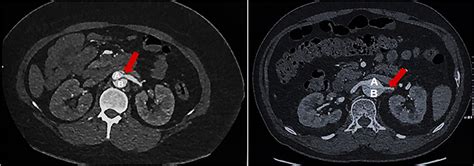 Frontiers Short Term Prognosis Of Renal Artery Stenosis Secondary To Acute Type B Aortic