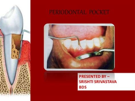 Periodontal Pockets