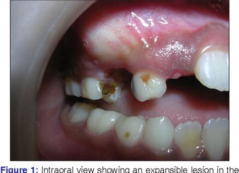 Figure From Conservative Management Of Unicystic Ameloblastoma In A