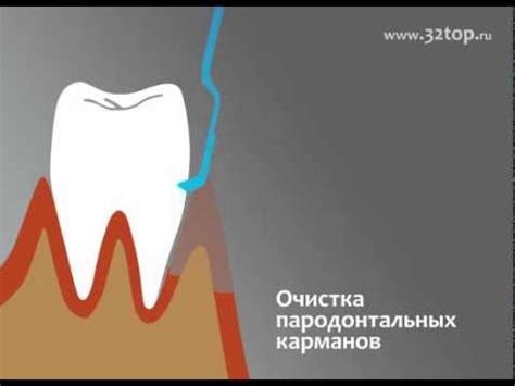 Открытый кюретаж - YouTube