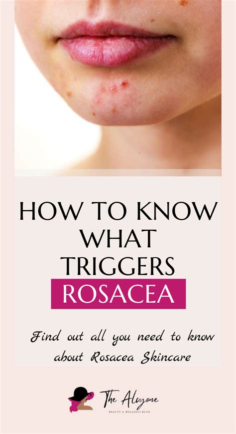 Rosacea causes triggers and skincare routine for rosacea – Artofit