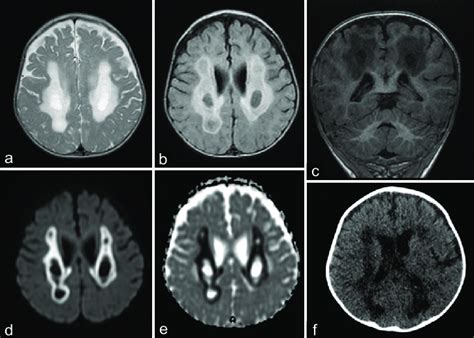 Brain MRI Axial T2 A And Flair B Coronal T1 C Diffusion D