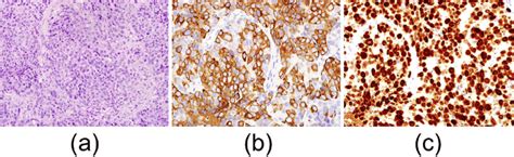 Figure2histopathological Findings Of Tumor Biopsy Specimens A