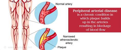 Peripheral Artery Disease Pad Causes Symptoms Diagnosis