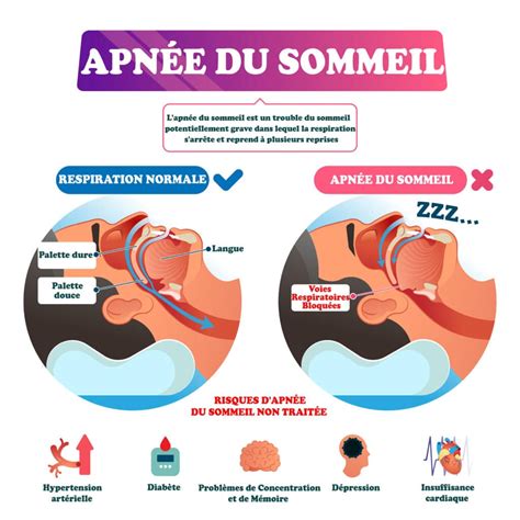 Syndrome Apnee Du Sommeil