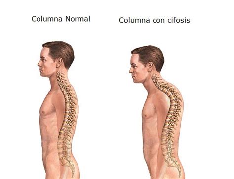 Síntomas causas y tratamientos de la cifosis Columna Vertebral