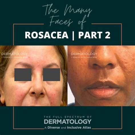 The Many Faces Of Rosacea Part Next Steps In Dermatology