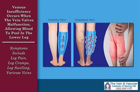 Venous insufficiency treatment – Artofit