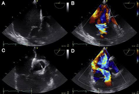 Tee In The Midesophageal Four Chamber View A And Color Doppler B