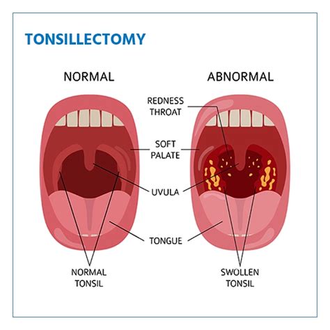 Tonsillektomie Indikationen Verfahren Und Genesung
