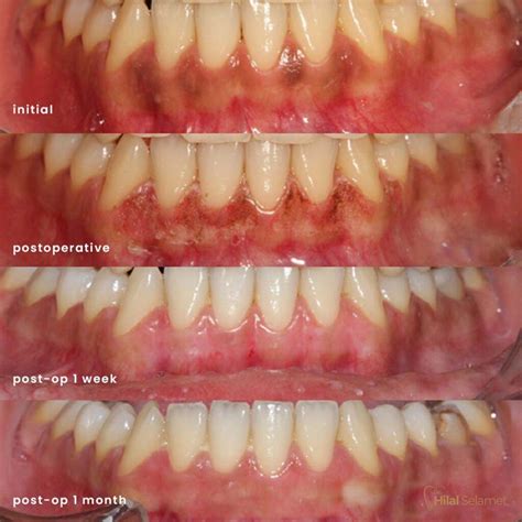 Diş Eti Renklenmesi ve Tedavisi Dr Hilal Selamet