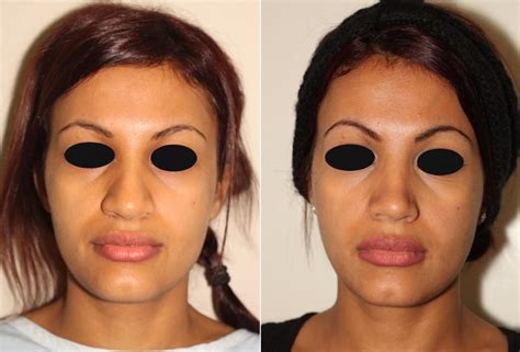 16 Rhinoplasty Dr Denton