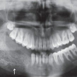 Orthopantomogram Opg Shows A Well Defined Multilocular Radiolucency