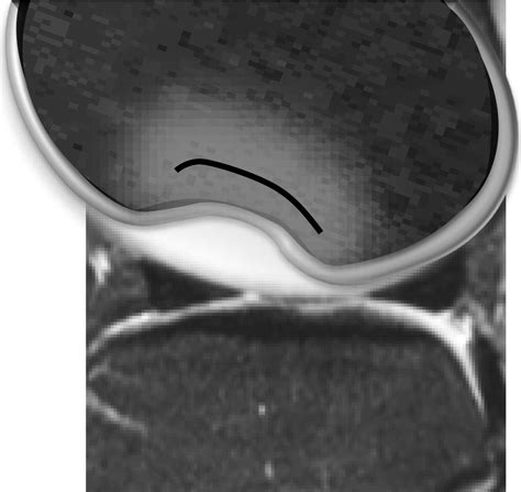 Osteochondral Lesions Of The Knee Differentiating The Most Common