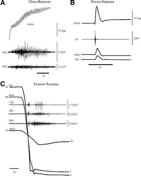 Kinematic And Electromyographic Measurements For Clonus Flexor Spasms