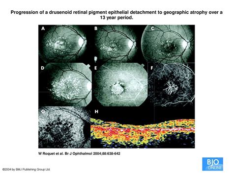 Drusenoid Pigment Epithelial Detachment