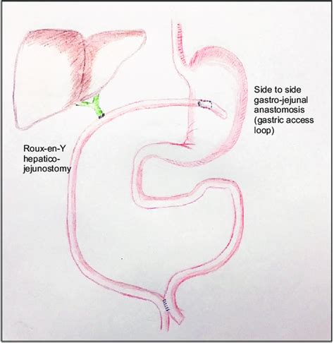 Diagrammatic Representation Of Hepaticojejunostomy With A Gastric