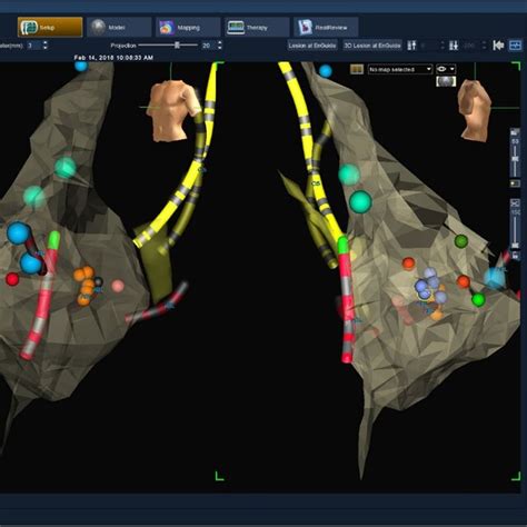 Simplified 3 Dimensional Electroanatomical Mapping The Right And Left