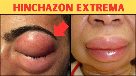 Angioedema que se hereda Síntomas y tratamiento YouTube