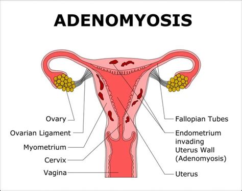 Endometriosis vs. Adenomyosis | ThisIsEndometriosis.com