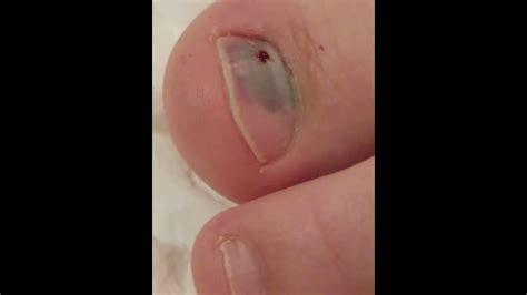 How To Pop Blood Blister Under Toenail - Nail Ftempo