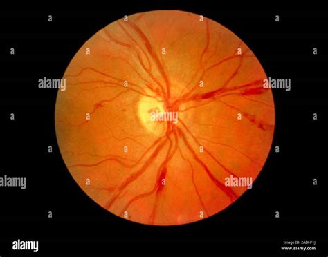 Retinal Vasculitis Ophthalmoscopy View Of The Retina Of The Eye