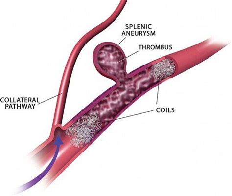 Splenic Artery Aneurysm Ultrasound