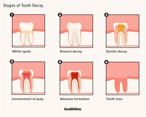 Dental Caries Progression