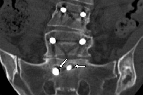 Sacral Fractures After Lumbosacral Fusion A Characteristic Fracture Pattern Ajr