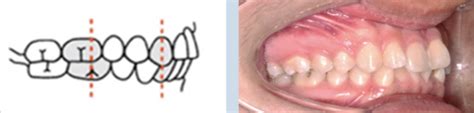 Introduction To Malocclusion Ortho Flashcards Quizlet