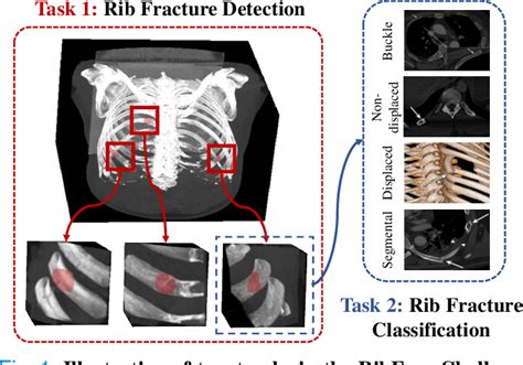 Figure 1 From Deep Rib Fracture Instance Segmentation And