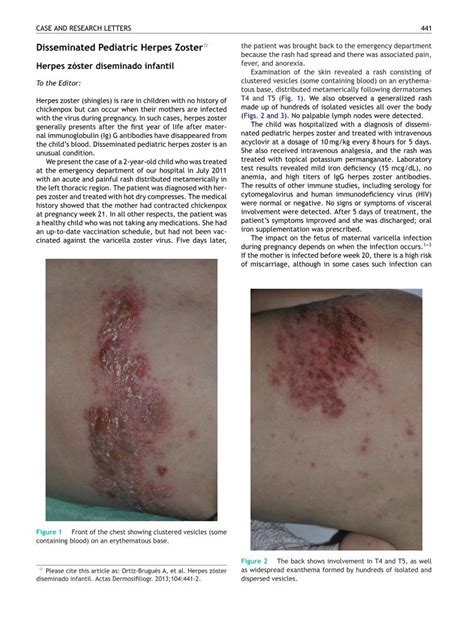 Pdf Disseminated Pediatric Herpes Zoster Dokumen Tips