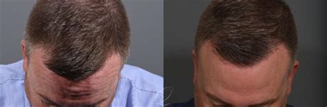 Male FUE Hair Transplant Before And After Pictures Case 1001522