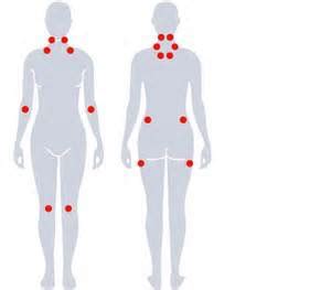 Fibromyalgia Tender Points Uk