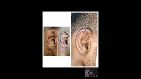 Ear Aesthetic Reshaping Surgery Cup Ear Adult Microtia Otoplasty Youtube