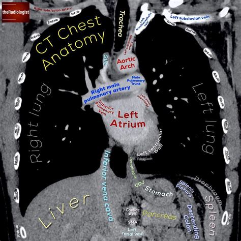 👨🏽‍💻Check out this coronal image of a chest CT with a cheeky glimpse of the upper abdomen in ...