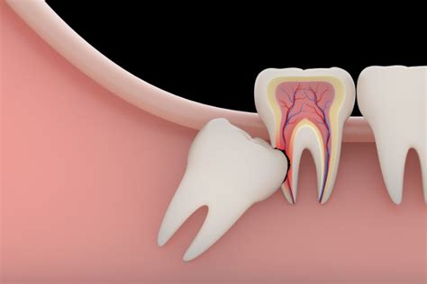 Wisdom Teeth Removal Surgery A Complete Guide Wisdom Teeth Factory