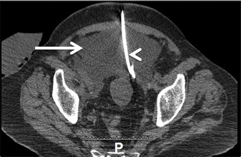 Pelvic Lymphocele Arrow With Interval Placement Of A Pigtail Drainage