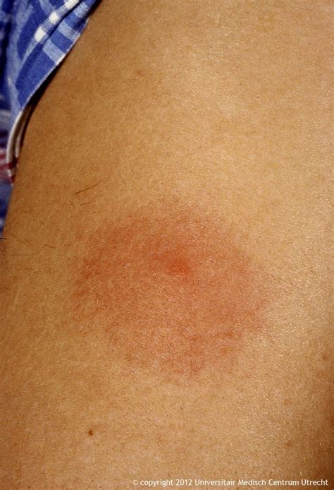 Lyme Disease Bullseye Rash