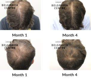 Hair Loss Success Story Very Pleased With The Results