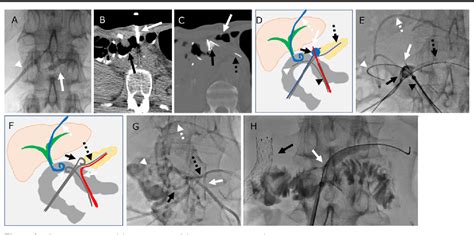 Figure 2 From Percutaneous Trans Jejunum Pancreatojejunostomy