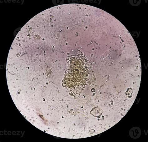 Microscopic Image Showing Calcium Oxalate Crystal And Others Urinary