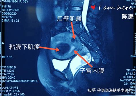 陈谦主任科普之多发性子宫肌瘤诊治 知乎