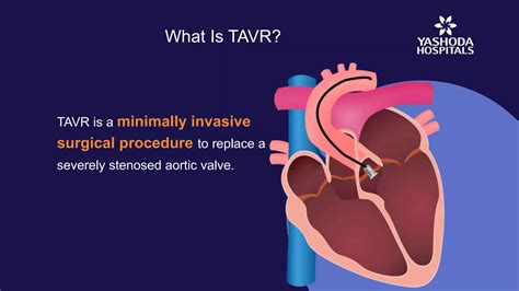 Transcatheter Aortic Valve Replacement Tavr Tavr Procedure At