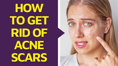 How To Get Rid Of Acne Scars Youtube